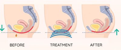 How the Pelvic Care Chair benefits women during therapy sessions